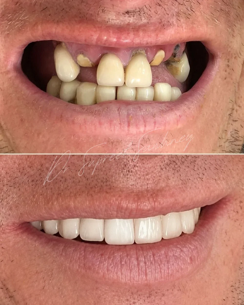 Before-and-after smile photographs documenting restoration of missing and fractured maxillary anterior teeth